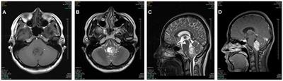 Intracranial tumors mimicking benign paroxysmal positional vertigo: A case series